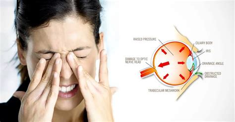 Surprising Signs You Have High Eye Pressure - Do You Have Any of These?